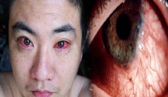 دواء لسرطان العين!