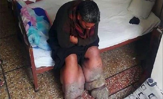 في حادثة مرعبة.. بعوضة تصيب رجلاً بداء الفيل! (فيديو) في حادثة مرعبة.. بعوضة تصيب رجلاً بداء الفيل! (فيديو)