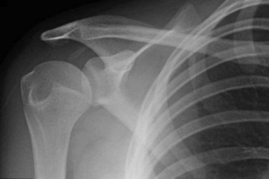 فتاة بريطانية تخلع كتفها كلما عطست