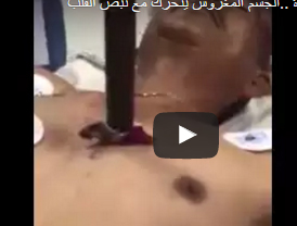 بالفيديو.. لقطات مُروِّعة لسكين يتحرك مع ضربات قلب مصاب بطعنة بالفيديو.. لقطات مُروِّعة لسكين يتحرك مع ضربات قلب مصاب بطعنة