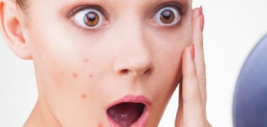 هذه الفتاة غسلت وجهها بمكون واحد وتخلصت من حب الشباب نهائياً!