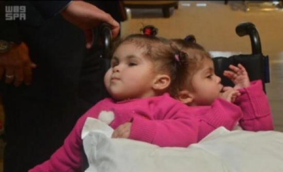 توأم سيامي مصري يبحثان عن علاج