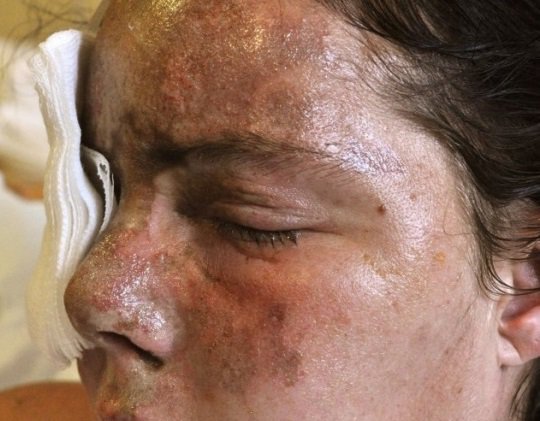 صور| تشويه وجه شابة بالأسيد.. شاهدوا كيف اصبحت؟!