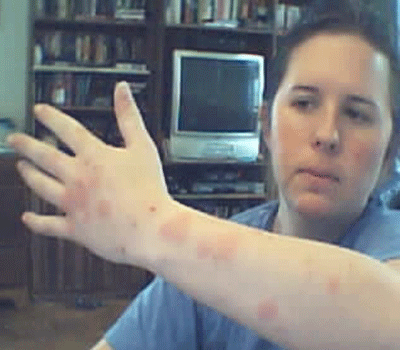 تجني 800 ألف دولار من لدغات البق