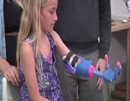 يد "مطبوعة" تعوض طفلة أميركية عن يدها المقطوعة