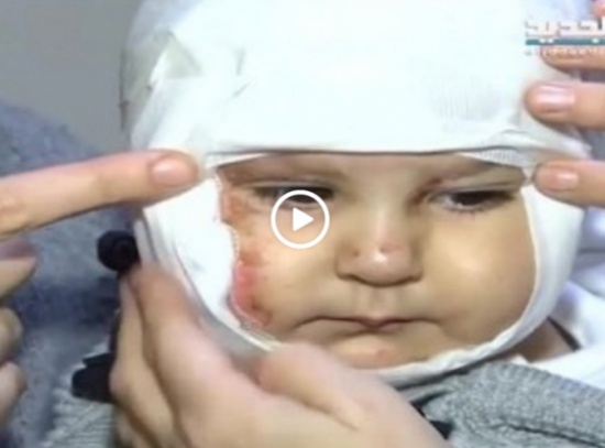 بالفيديو : حروق بالغة في وجه طفلة بسبب مفرقعات نارية طائشة في لبنان بالفيديو : حروق بالغة في وجه طفلة بسبب مفرقعات نارية طائشة في لبنان