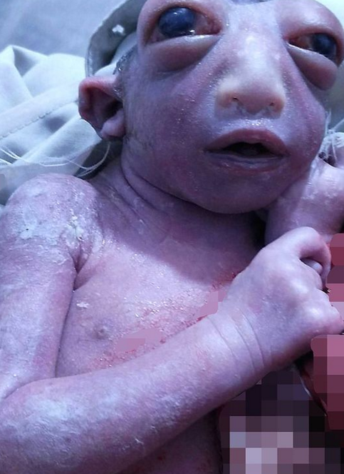 حالة ولادة غريبة لطفلة بنصف رأس حالة ولادة غريبة لطفلة بنصف رأس