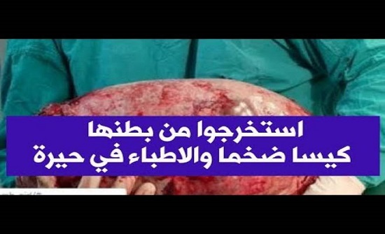 استخرجوا من بطنها 'كيسا' ضخما.. والأطباء في حيرة استخرجوا من بطنها 'كيسا' ضخما.. والأطباء في حيرة