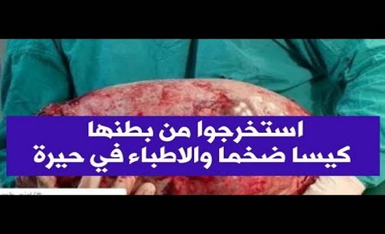 استخرجوا من بطنها 'كيسا' ضخما.. والأطباء في حيرة