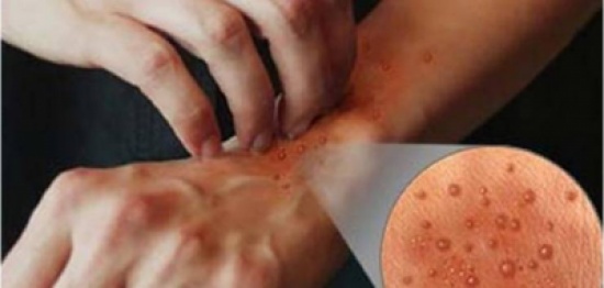 أسباب الجرب وأعراضه وكيفية علاجه وطريقة الوقاية منه! أسباب الجرب وأعراضه وكيفية علاجه وطريقة الوقاية منه!