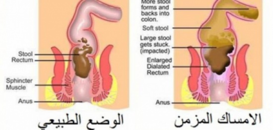 معالجة الامساك بوصفات منزلية بسيطة معالجة الامساك بوصفات منزلية بسيطة