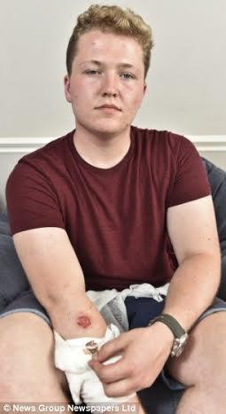 "آيفون 5" يتسبب في حرق مزمن بذراع بريطاني