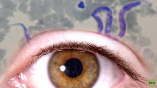 استئصال دودة طولها 12 سم من عين امرأة