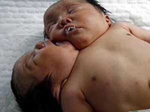 ولادة طفلة برأسين في الصين 