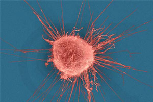 أيرلندية تقهر السرطان 6 مرات وتواجهه للمرة السابعة