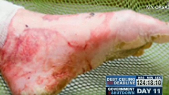 مخدر يحول متعاطيه إلى "زومبي"