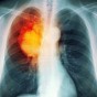 الرئة - أرشيفية