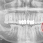 50 ألف إسترليني تعويضاً  عن خلع ضرس العقل