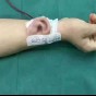 يد المريض بعد زراعة الاذن فيها
