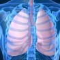 إلتهاب الرئة