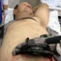 اخترق المنشار الكهربائي الدائري بطن الرجل لعمق 10 سنتيمترات