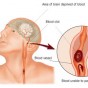 أسباب الجلطة الدماغية كثيرة