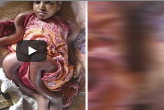 بالفيديو.. حالة نادرة لانكماش قدم فتاة عمرها 25 عاما