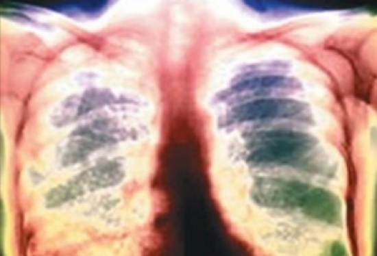 جهاز طبي للكشف عن السل بساعتين في الأردن