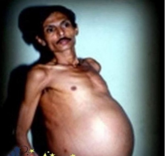 رجل يدخل المستشفى بسبب انتفاخ بطنه والصدمة !!