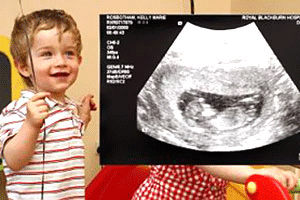 طفل بريطاني بنصف مخ يتحدى الأطباء ويمشي ويتكلم