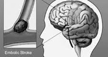 6 نصائح هامة للوقاية من الإصابة بالخرف 6 نصائح هامة للوقاية من الإصابة بالخرف