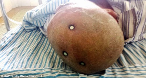 بالصور ..استخراج ثلاثة مسامير من راس صيني