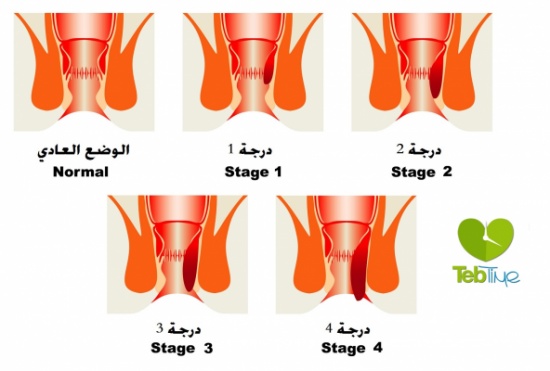 من أين تأتي البواسير.. وكيف تعالجونها ؟! من أين تأتي البواسير.. وكيف تعالجونها ؟!
