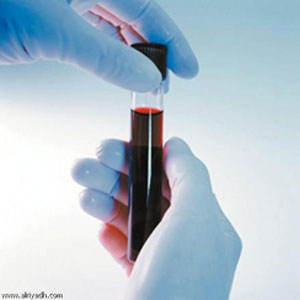 رئيس جميعة الثلاسيميا والهيموفيليا يؤكد حاجتهم للرعاية والدعم