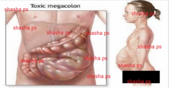 لهذا السبب أنتم تعانون من انتفاخ البطن.. وهكذا تحلون المشكلة!
