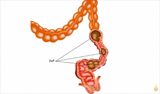 أيهما أفضل للتغوط.. القرفصاء أم جلسة الكرسي؟