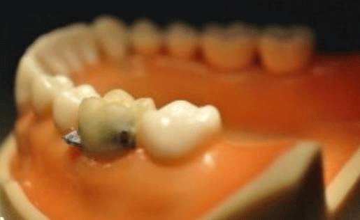 أسنان ذكية تراقب طعامك وشرابك أسنان ذكية تراقب طعامك وشرابك