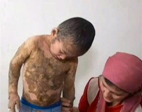 مرض نادر يحول طفلاً إلى "سحلية" مرض نادر يحول طفلاً إلى "سحلية"