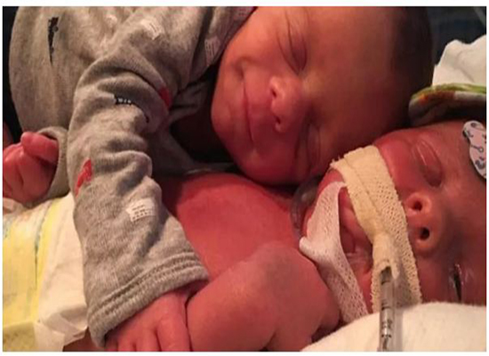 صورة مؤلمة : رضيع يحتضن توأمه الميت
