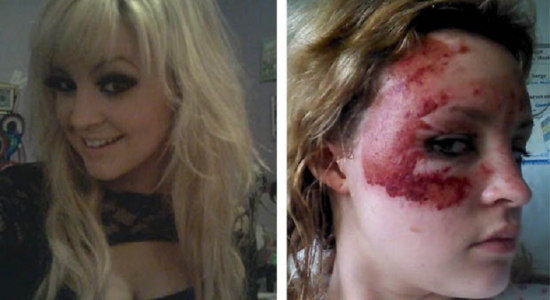 فتاة تخوض مسابقة لملكات الجمال رغم إصابتها بحروق فى بريطانيا