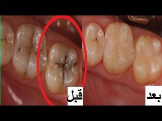 مع هذا اللقاح.. وداعًا لتسوس الأسنان! مع هذا اللقاح.. وداعًا لتسوس الأسنان!