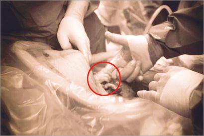 مولودة تمسك يد الطبيب وتخرج من رحم والدتها