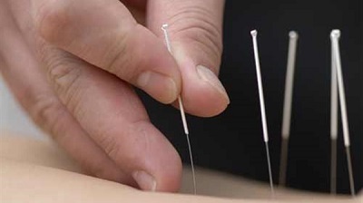 الإبر الصينية لا تفيد في إنقاص الوزن الإبر الصينية لا تفيد في إنقاص الوزن
