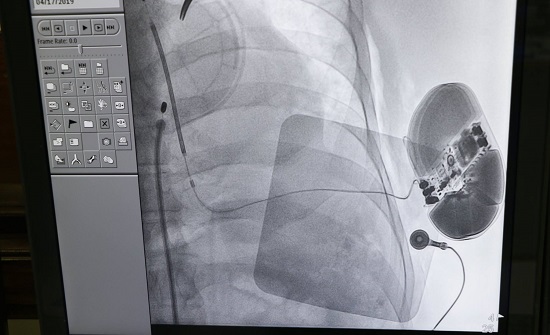 زراعة جهاز صاعق تحت الجلد في مستشفى الجامعة الأردنية