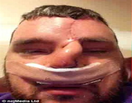 بالصور.. رجل يستيقظ ليجد أنفه مشوهة
