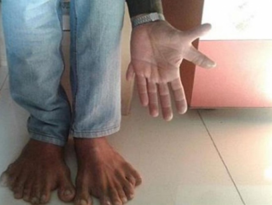 شاهد بالفيديو كم اصبعا يملك هذا الرجل ! شاهد بالفيديو كم اصبعا يملك هذا الرجل !