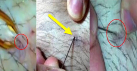 فيديو : اخرج شعرة تنمو تحت جلده طولها 4 سم - تعلم لكي تستطيع علاج نفسك!! فيديو : اخرج شعرة تنمو تحت جلده طولها 4 سم - تعلم لكي تستطيع علاج نفسك!!