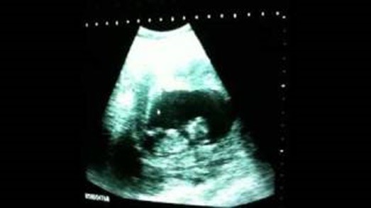 شاهد.. لقطات ترصد جنيناً يلعب "جمبازاً" في رحم أمه