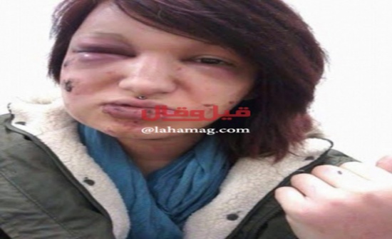 عضّ وجه صديقته السابقة 21 مرة... وما قاله عن السبب لا يُصدّق