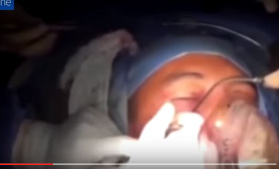 فيديو+18: شاهد لحظة إزالة الأطباء قنبلة من رأس جندي